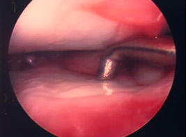 Artroscopia