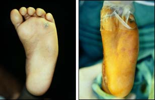 Deformazioni crescita