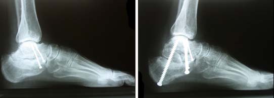 Deformazioni post traumatiche