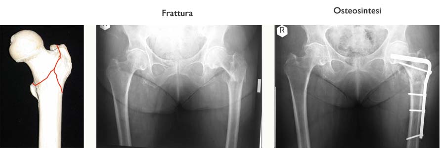 Frattura2